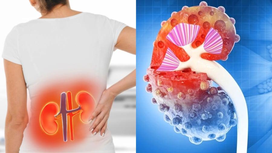 Suy thận dẫn tới cơ thể luôn ở trọng trạng thái mệt mỏi.