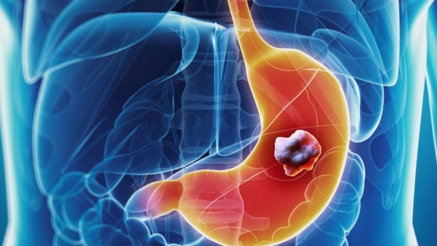 7 dấu hiệu ung thư dạ dày giai đoạn sớm, ai cũng cần biết kẻo di căn xa