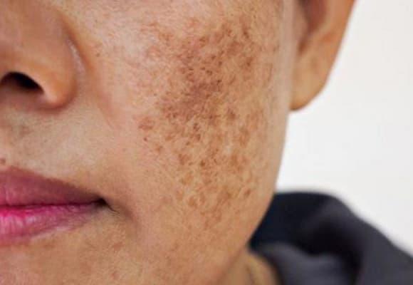 ung thư, dấu hiệu ᴜng thư, 5 bộ phận thȃm ᵭen phát hiện ᴜng thư